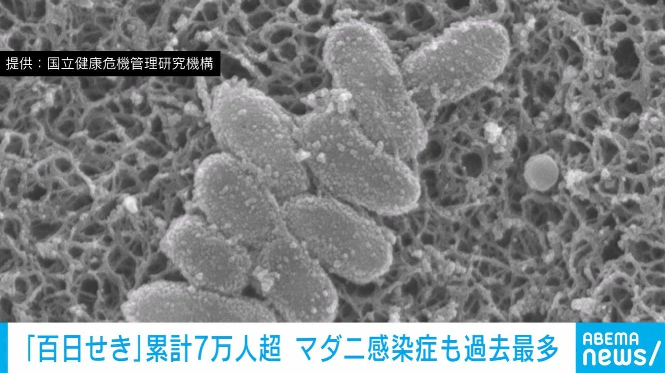 Japan Hits Grim Milestone with 70,000+ Whooping Cough Cases