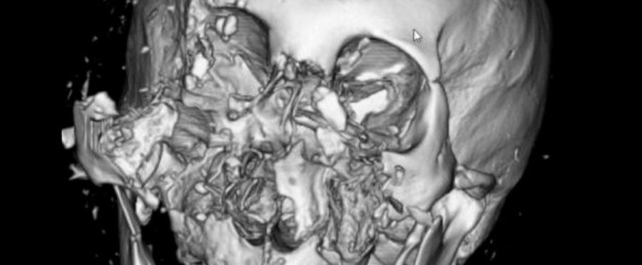 Nature's Medical Marvel: Bear Attack Survivor's Nose Reattached!