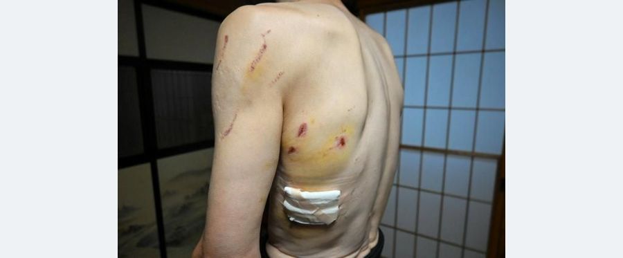 Close Encounter: Man Survives Sudden Bear Attack in Japan