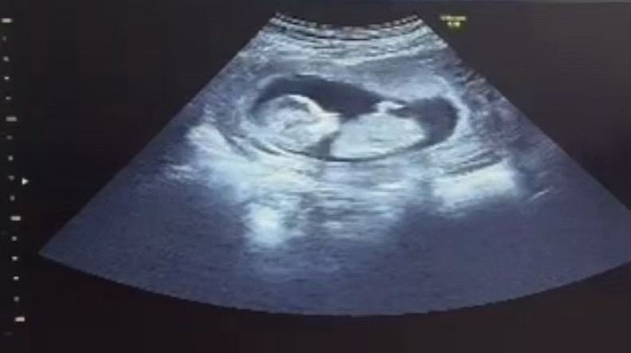 Choosing Surrogacy in the Face of Infertility – A Bold Move in Japan